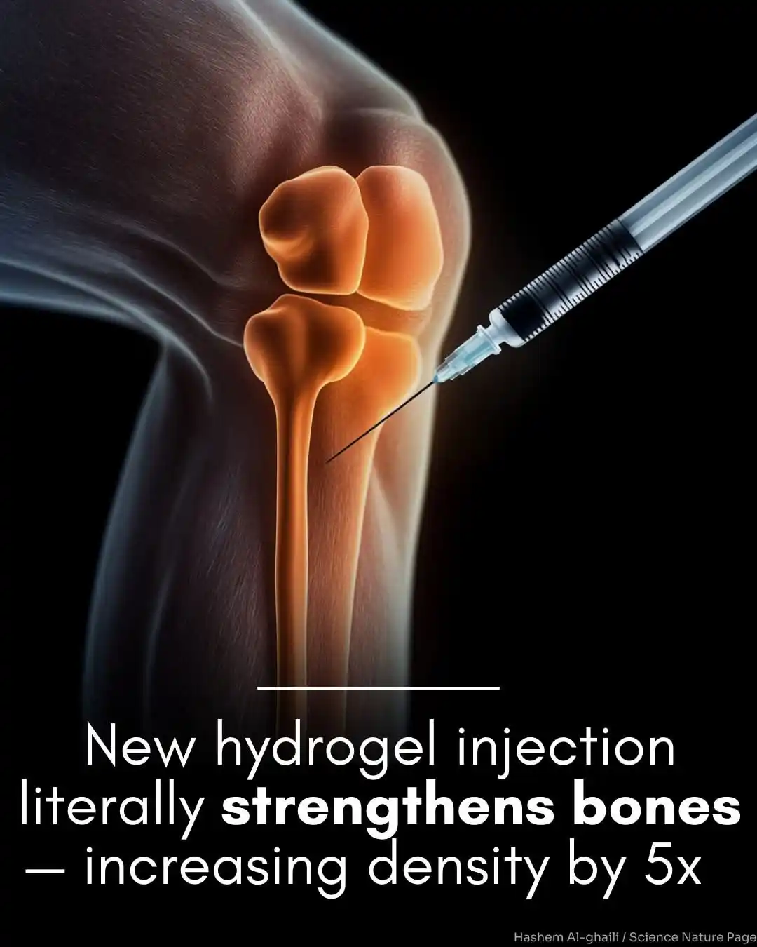 Image from DOCTOR NEWS: Scientists have created a hydrogel that strengthens bones in weeks. Bo...