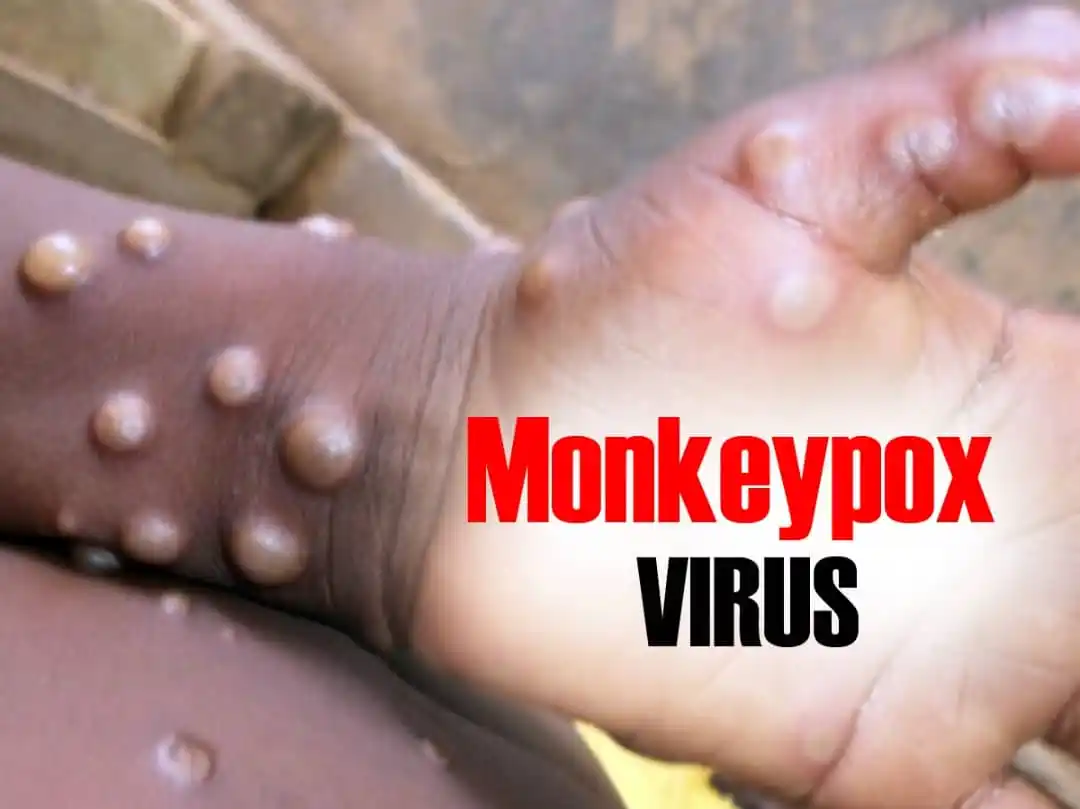 Image from Afrogazette News: *📰Gauteng Confirms Three New Mpox Cases Tied to Travel in Uganda* ...