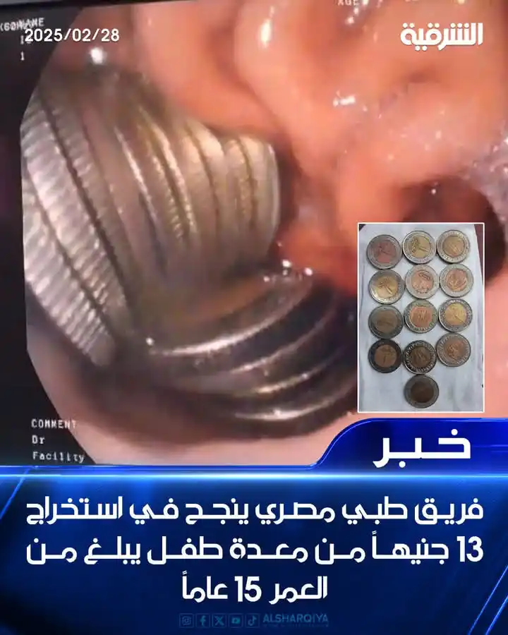 Image from اخبار واعلانات 📡اخبار متنوعة📡: ✵اخبار _متنوعة↜الشرقية_نيوز ✵الجمعة 28 فبراير 2025 ◼️فريق طبي مصري ين...