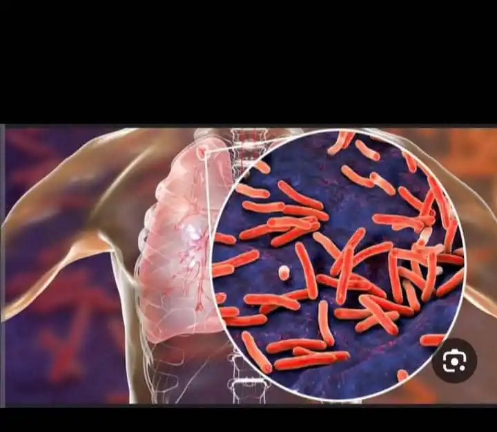 Image from عــآلــم آلـمــعـــ📖ــرفـهہ❤🔥📌: ال tuberculosis🦠🦠 📍طبعا كلنا نعرف مرض السل لكن هل حد يعرف اعراضه أو...