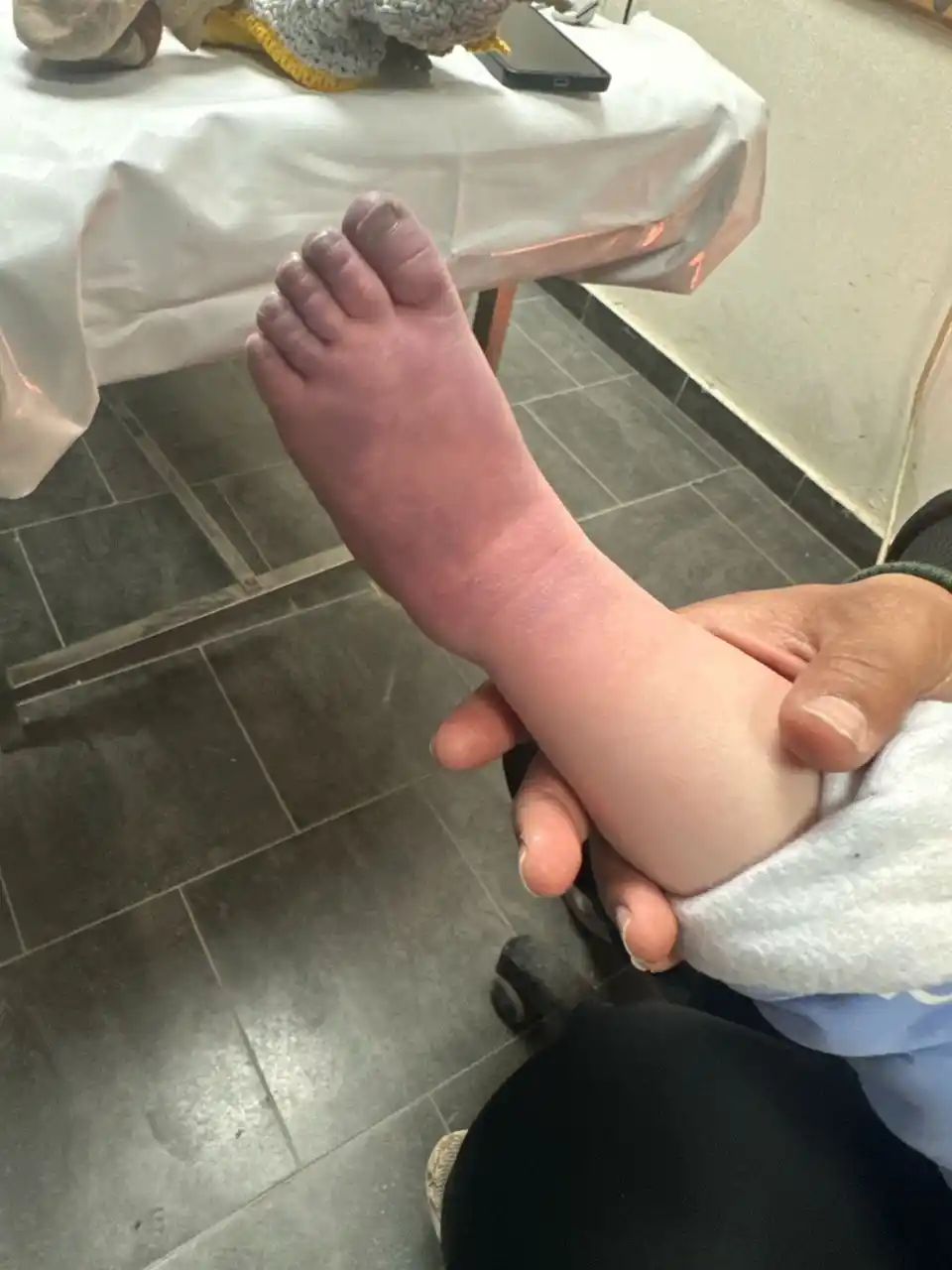 Image from منصة الميدان: 🛑 هذه الصورة لقدم طفلة توفيت بغزة بسبب البرد وصلت لمجمع ناصر الطبي تظ...