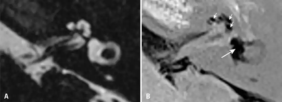 Image from e-Radiologia: [einstein - São Paulo] O papel da ressonância magnética na doença de M...